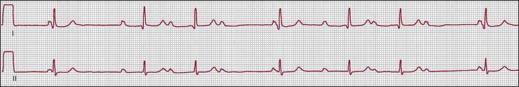 Bradyarrhythmias And Conduction Blocks Revista Espanola De Cardiologia