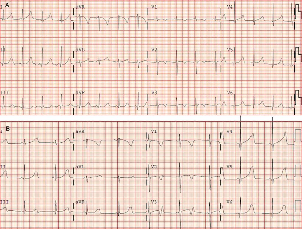 Flecainide, a Therapeutic Option in a Patient With Long QT Syndrome ...