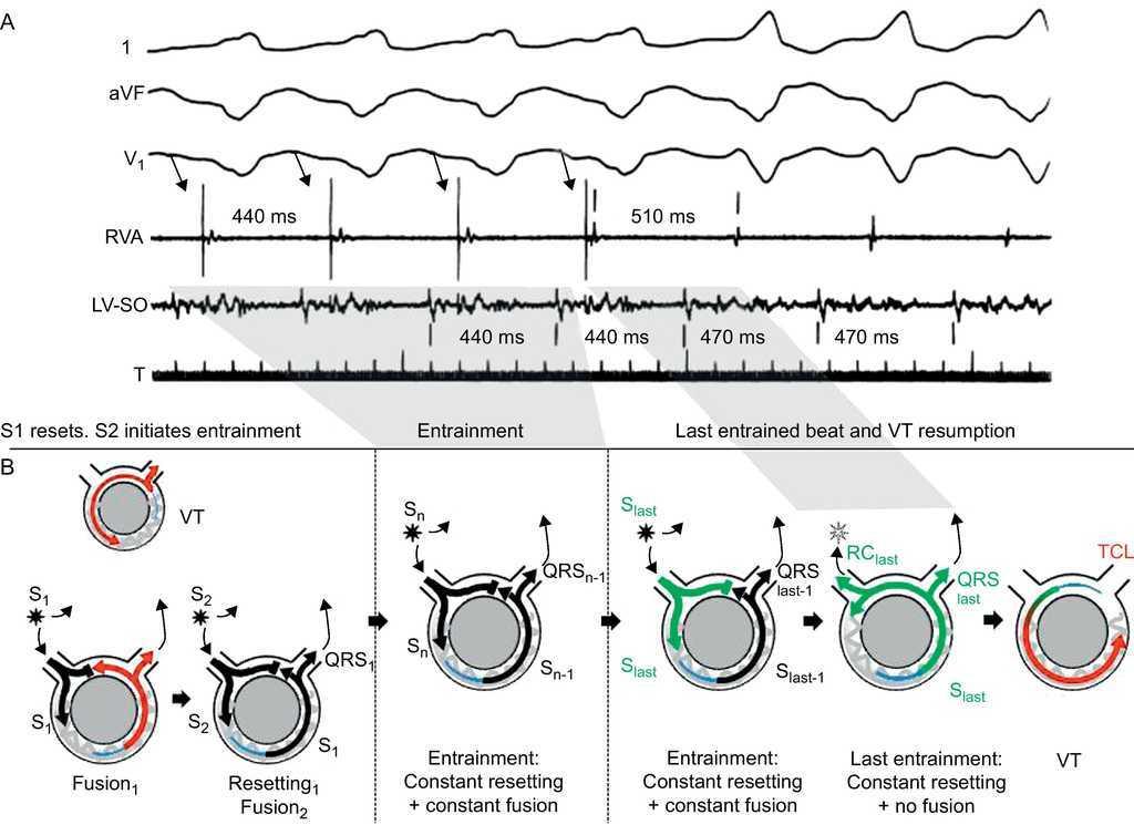 Ventricular Tachycardia In Coronary Artery Disease Revista Espanola De Cardiologia Ventricular Tachycardia In Coronary Artery Disease Revista Espanola De Cardiologia