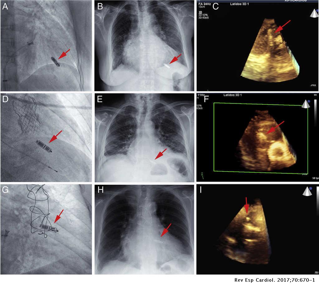 Usefulness of Three-dimensional Transthoracic Echocardiograhy in the ...