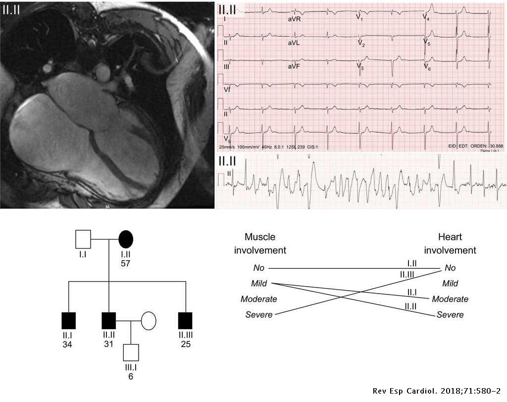 Cardiac Manifestations Of Neuromuscular Disease Revista Espanola De Cardiologia Cardiac Manifestations Of Neuromuscular Disease Revista Espanola De Cardiologia