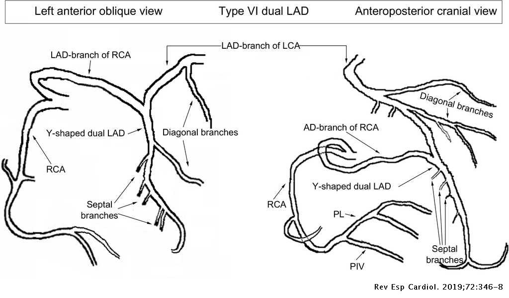 Y Shaped Dual Left Anterior Descending Artery Or Coronary Collateral Circulation Revista Espanola De Cardiologia