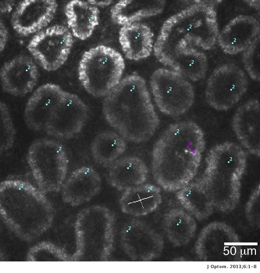 Historical Overview Of Imaging The Meibomian Glands Journal Of Optometry