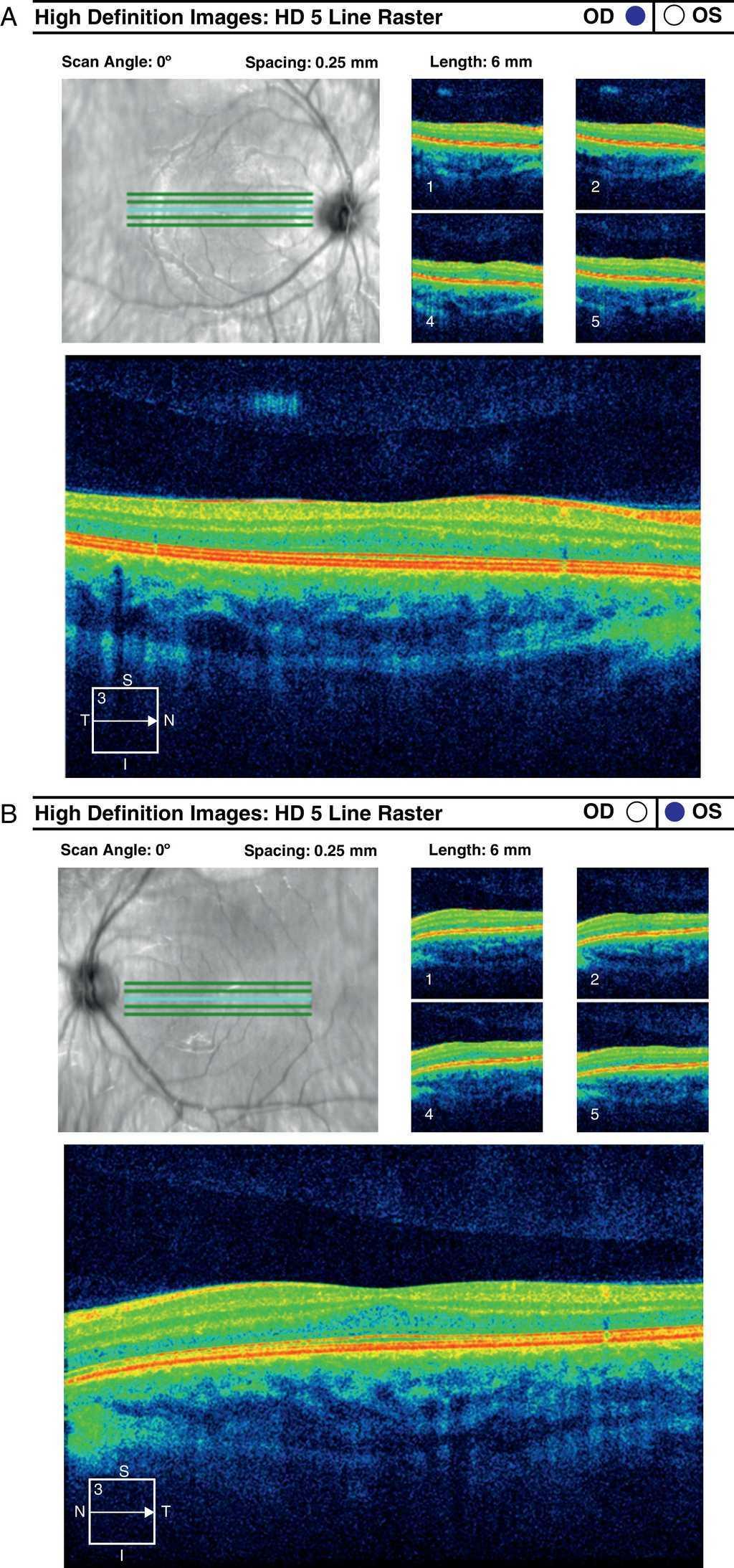 Macular pigment optical density spatial distribution measured in a