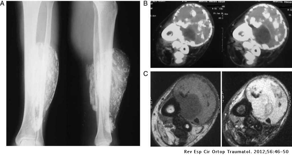 Mionecrosis de la pierna | Revista Española de Cirugía Ortopédica y Traumatología