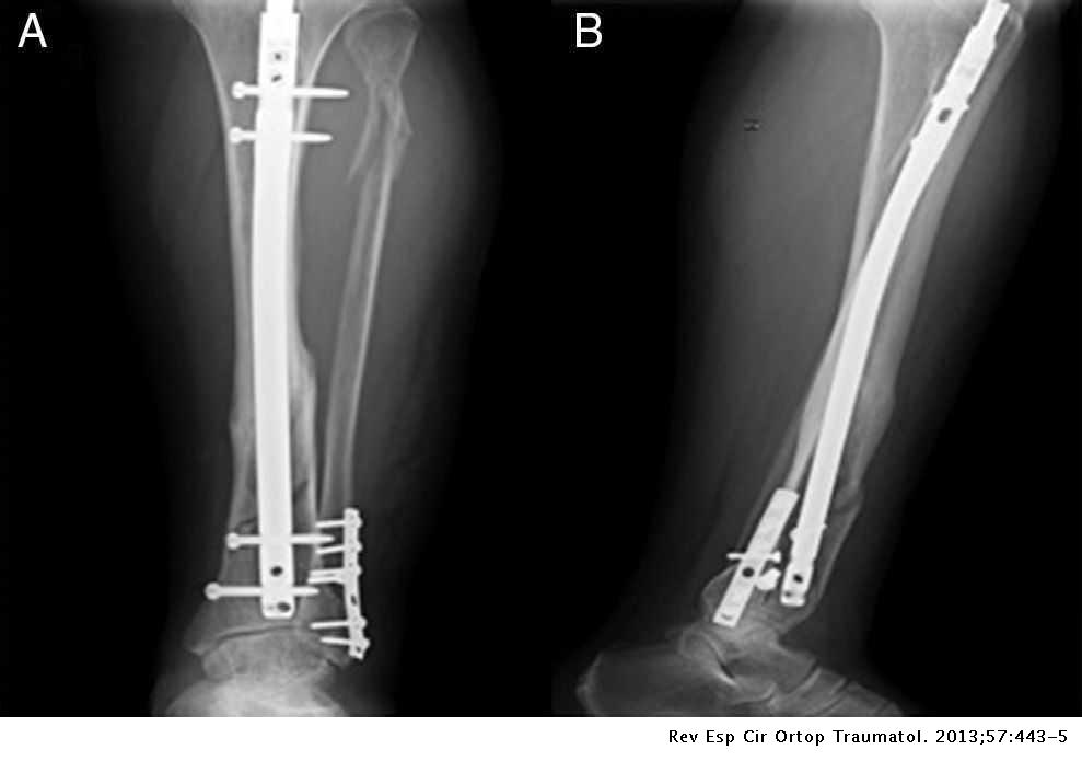 Department Quote defect Distal tibia peri-implant fracture with an intramedullary nail: A case  report | Revista Española de Cirugía Ortopédica y Traumatología (English  Edition)