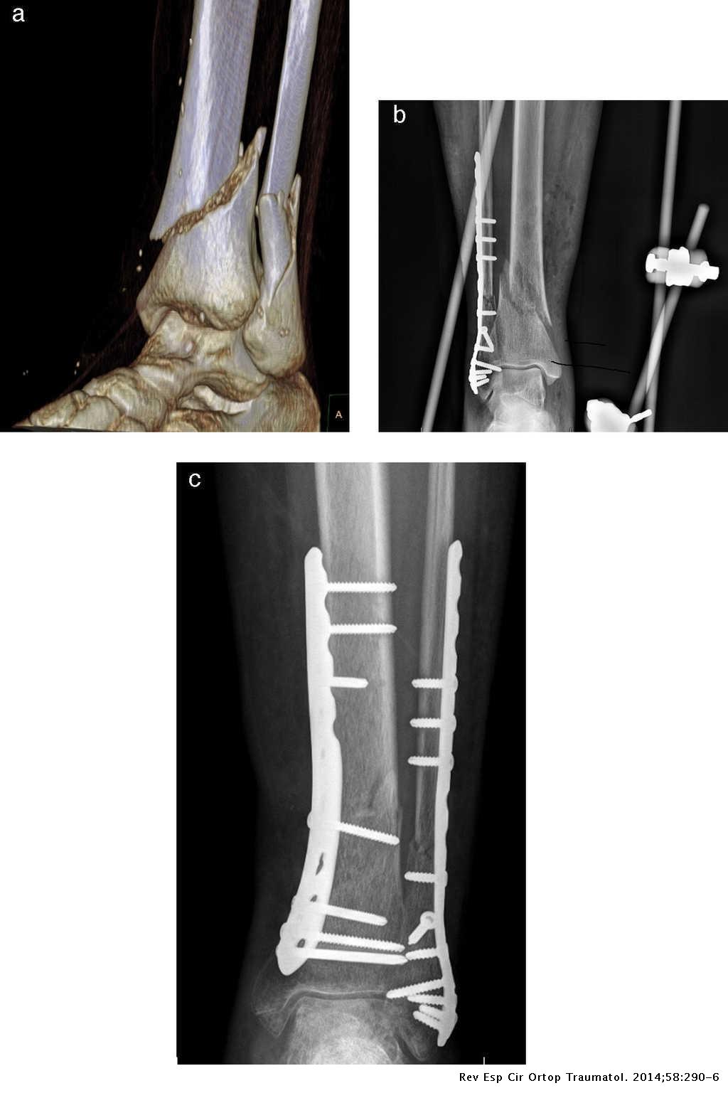 Percutaneous osteosynthesis in tibial pilon fractures. Does the surgical  technique determine the final result? | Revista Española de Cirugía  Ortopédica y Traumatología (English Edition)