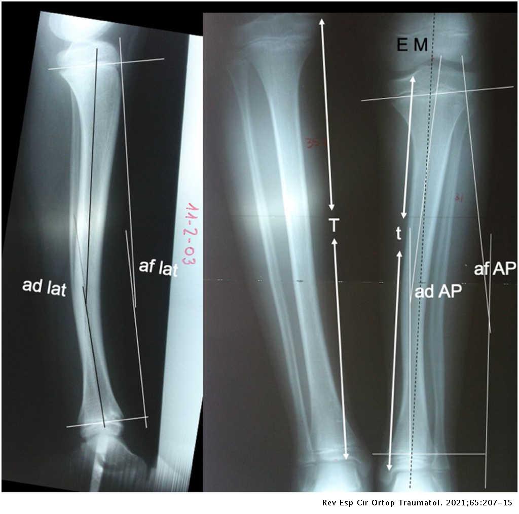 Posteromedial tibial deformity: Radiological evolution and treatment of ...