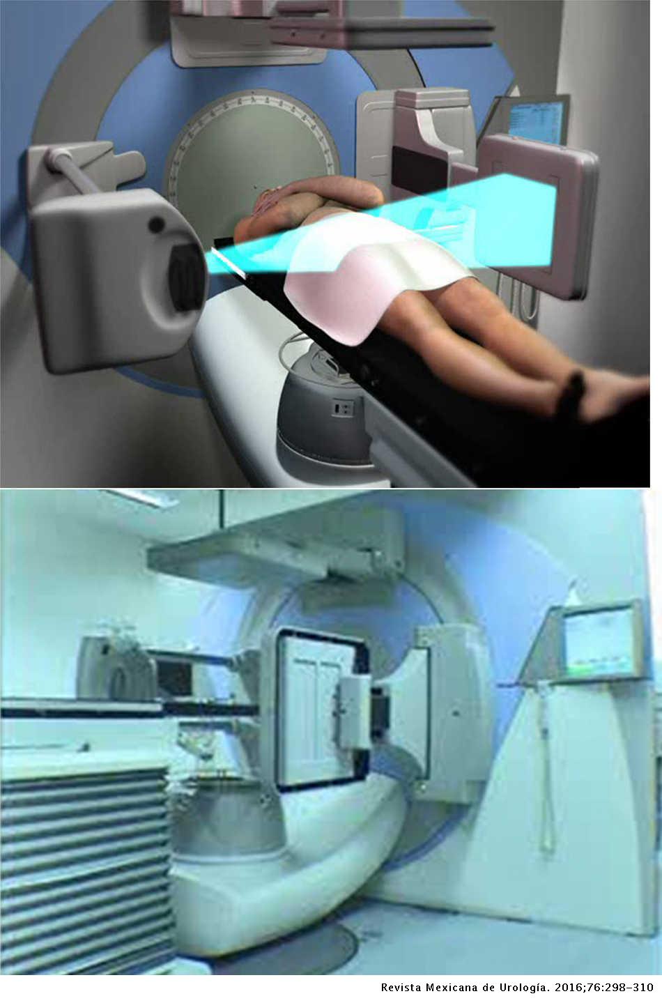 radioterapia en cáncer de próstata pdf)