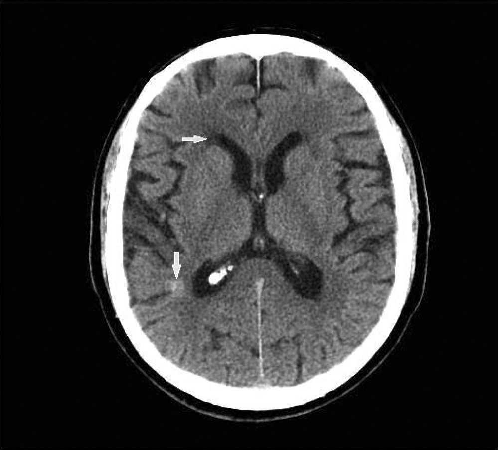 Estudio Mediante Tomografia Computarizada Resonancia Magnetica De Un Angioma Cavernoso Imagen Diagnostica