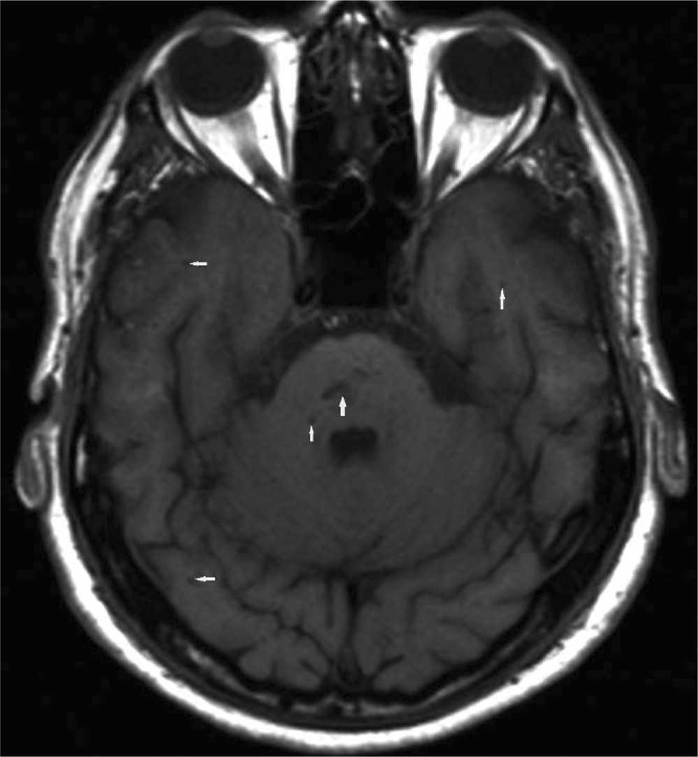 Estudio Mediante Tomografia Computarizada Resonancia Magnetica De Un Angioma Cavernoso Imagen Diagnostica