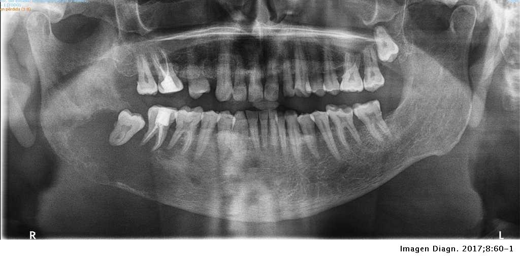 Carcinoma epidermoide intraóseo primario de mandíbula | Imagen Diagnóstica
