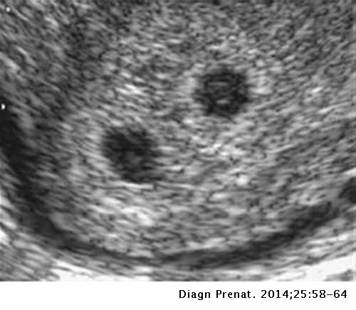 Twin pregnancy ultrasound images