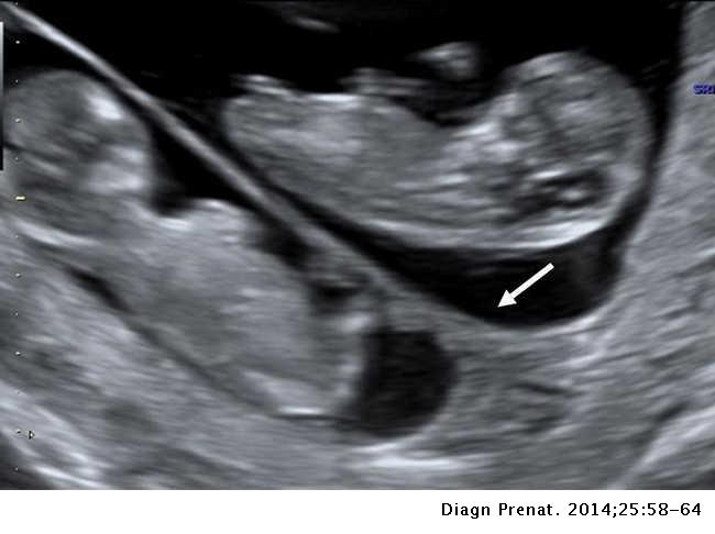 Diagnosis of chorionicity: The role of ultrasound | Diagnóstico Prenatal