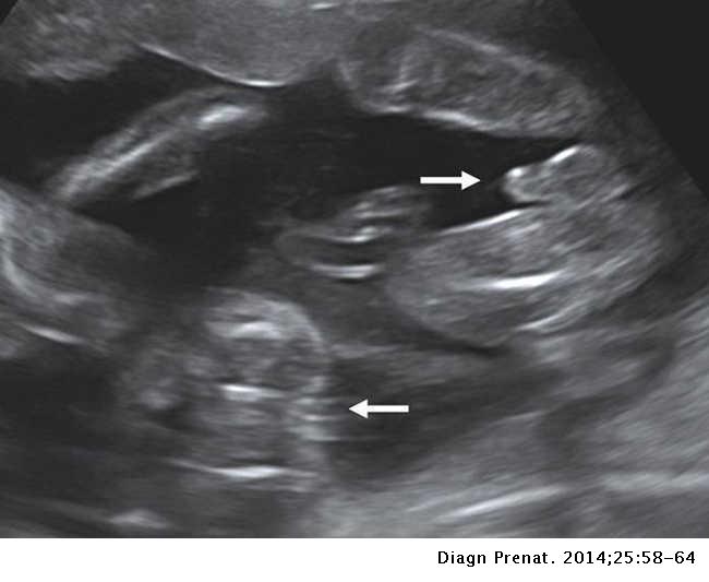 Trimester ultrasound second Diagnosis of