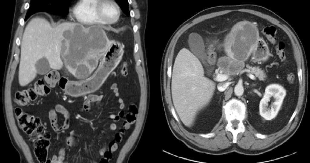 Non-functioning Primary Neuroendocrine Tumor of the Liver With ...