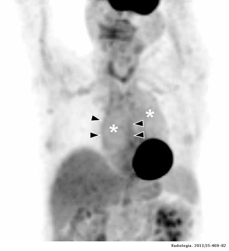 Nonurgent aortic disease: Clinical-radiological diagnosis of aortitis ...