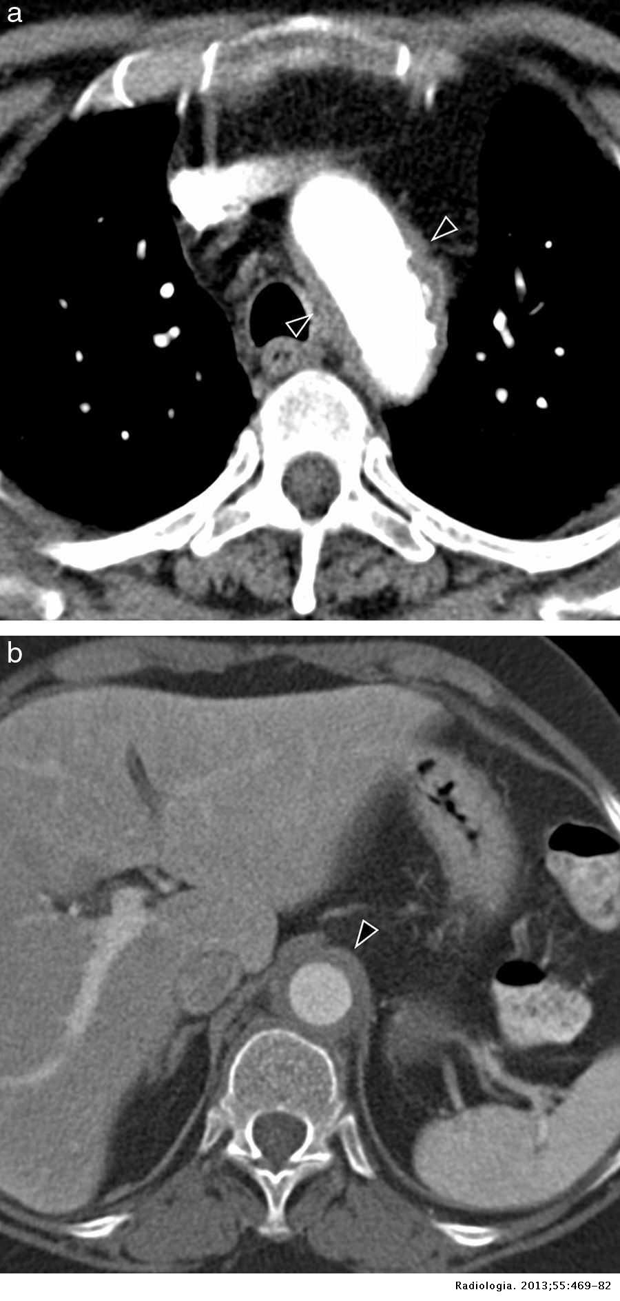 Nonurgent aortic disease: Clinical-radiological diagnosis of aortitis ...