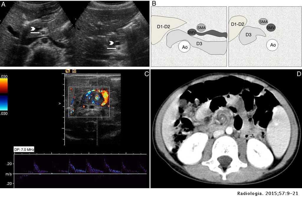 Intestinal malrotation – volvulus: Imaging findings | Radiología ...