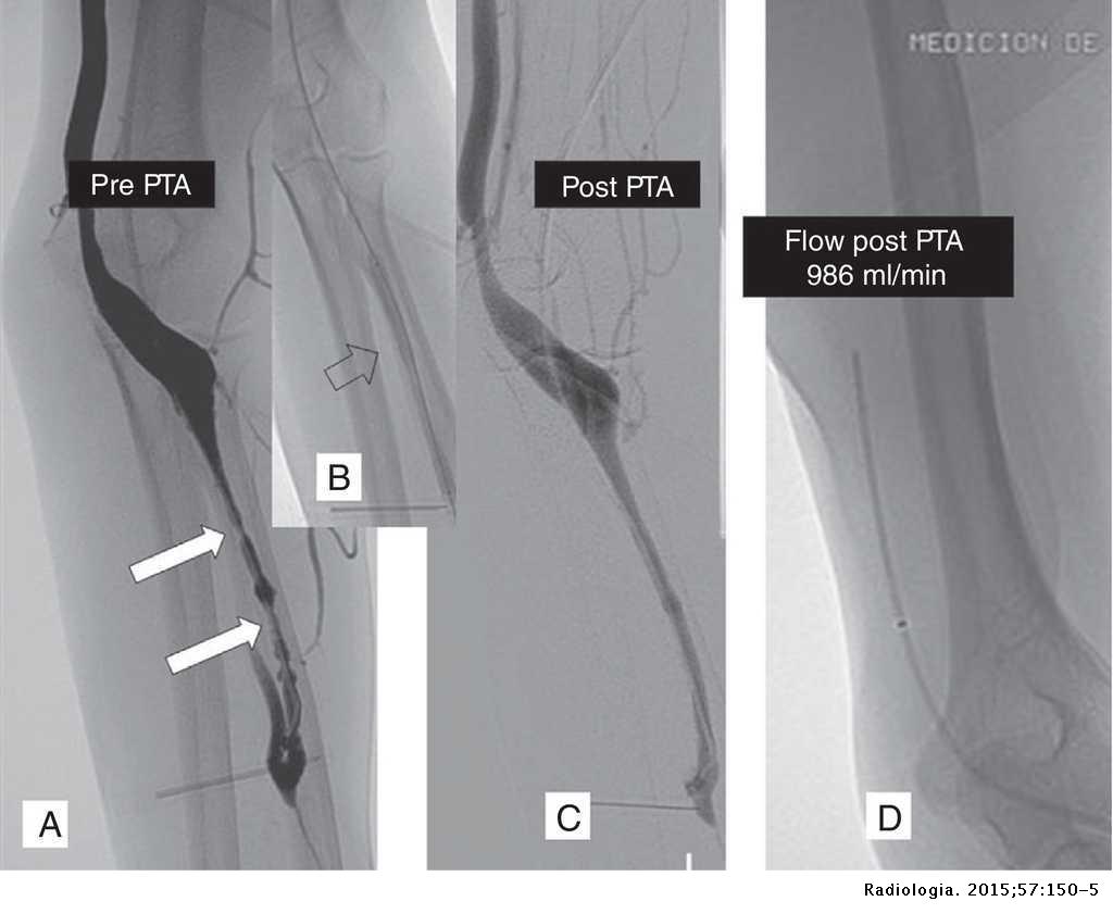 Invasive radiologic management of hemodialysis fistulas: Measuring flow ...