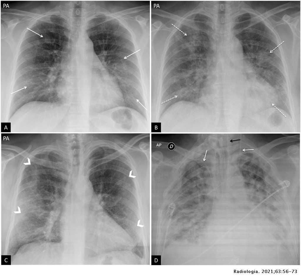 can mesothelioma be misdiagnosed as copd