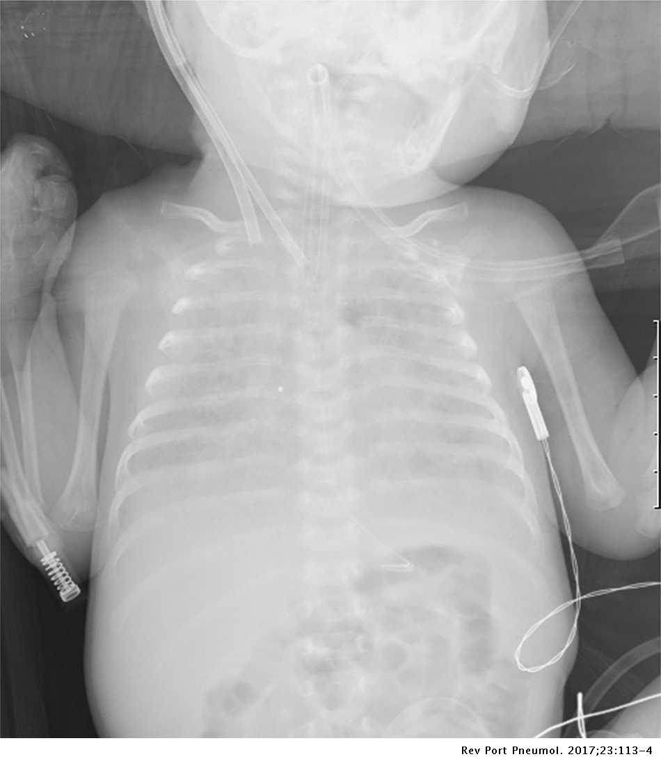 Neonatal respiratory failure due to ABCA3 deficiency Pulmonology