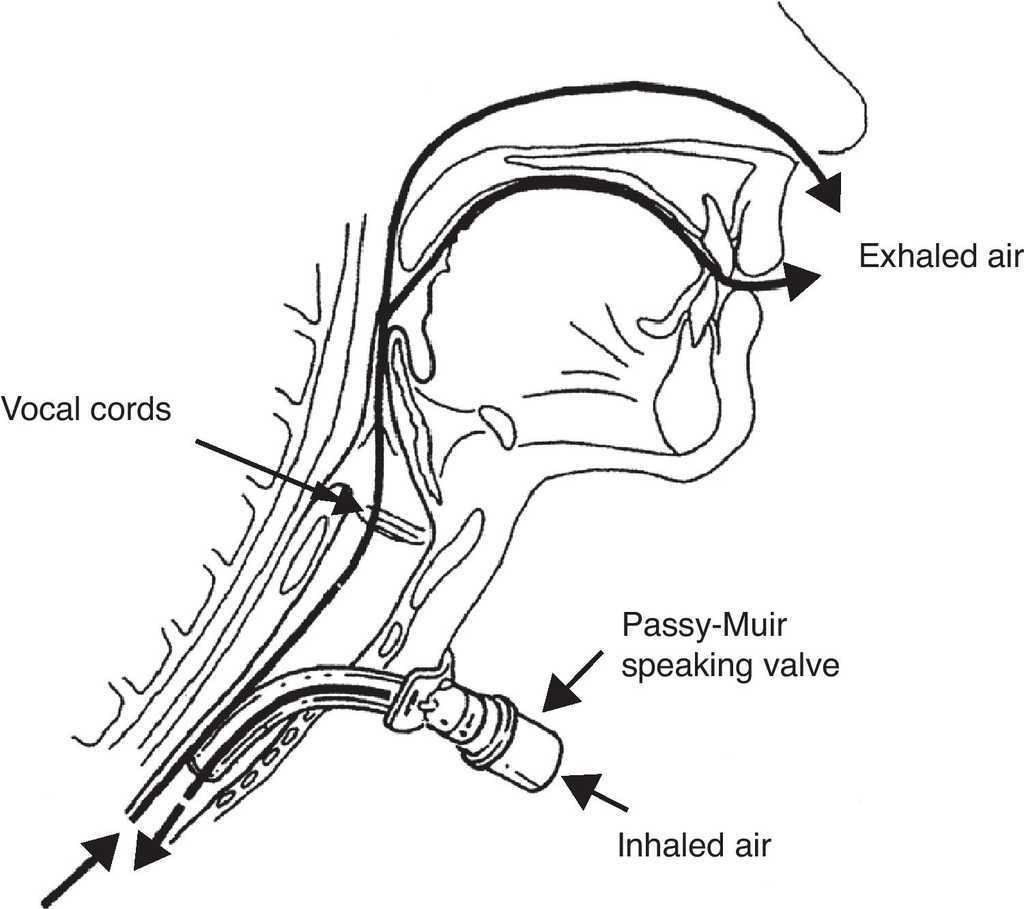 Exploration and approach to artificial airway dysphagia | Medicina ...