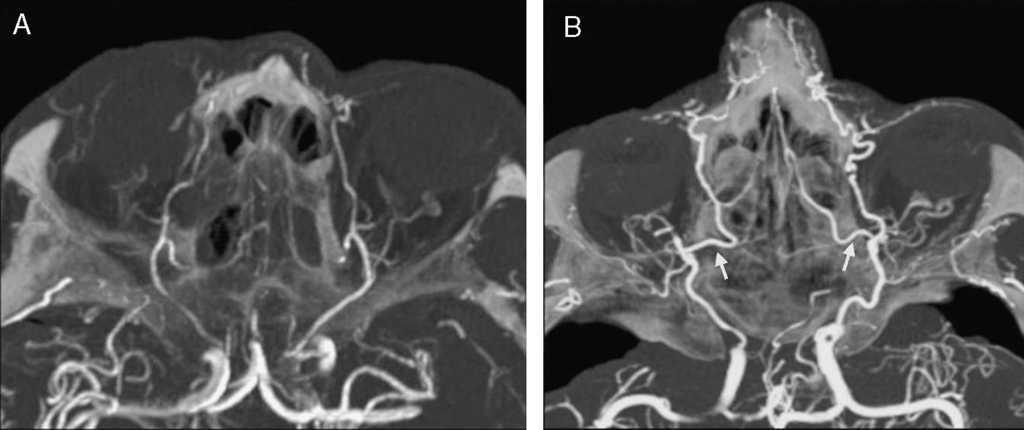Radiological Anatomy of the Ethmoidal Arteries: CT Cadaver Study | Acta ...