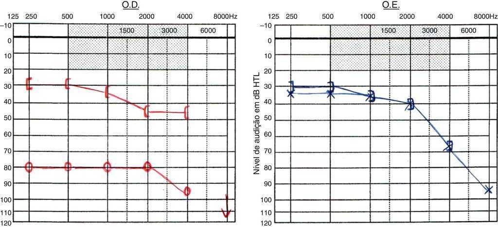 Osteogenesis Imperfecta and Hearing Loss—Description of Three Case ...