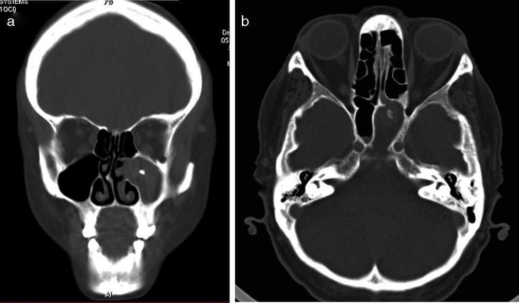 Fungus Ball of the Paranasal Sinuses: Analysis of Our Serie of Patients ...