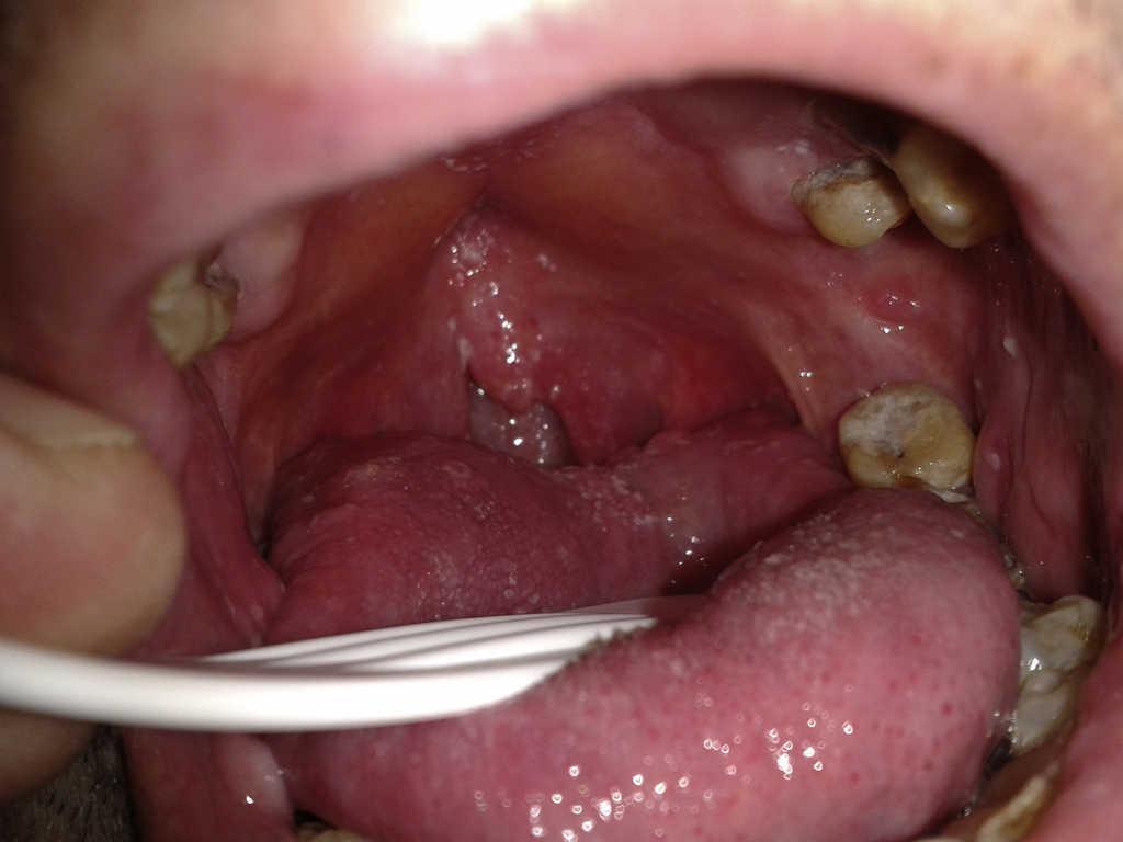 Otorhinolaryngology Manifestations Secondary To Oral Sex