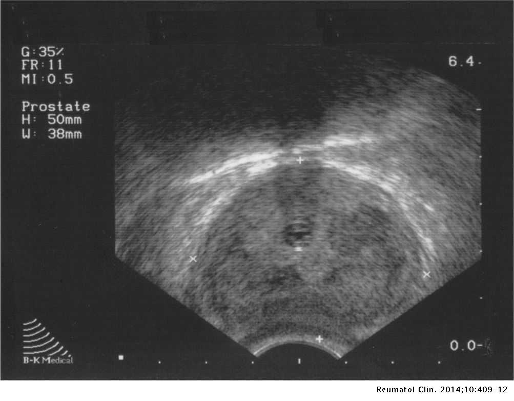 prostatitis ultrasound images)