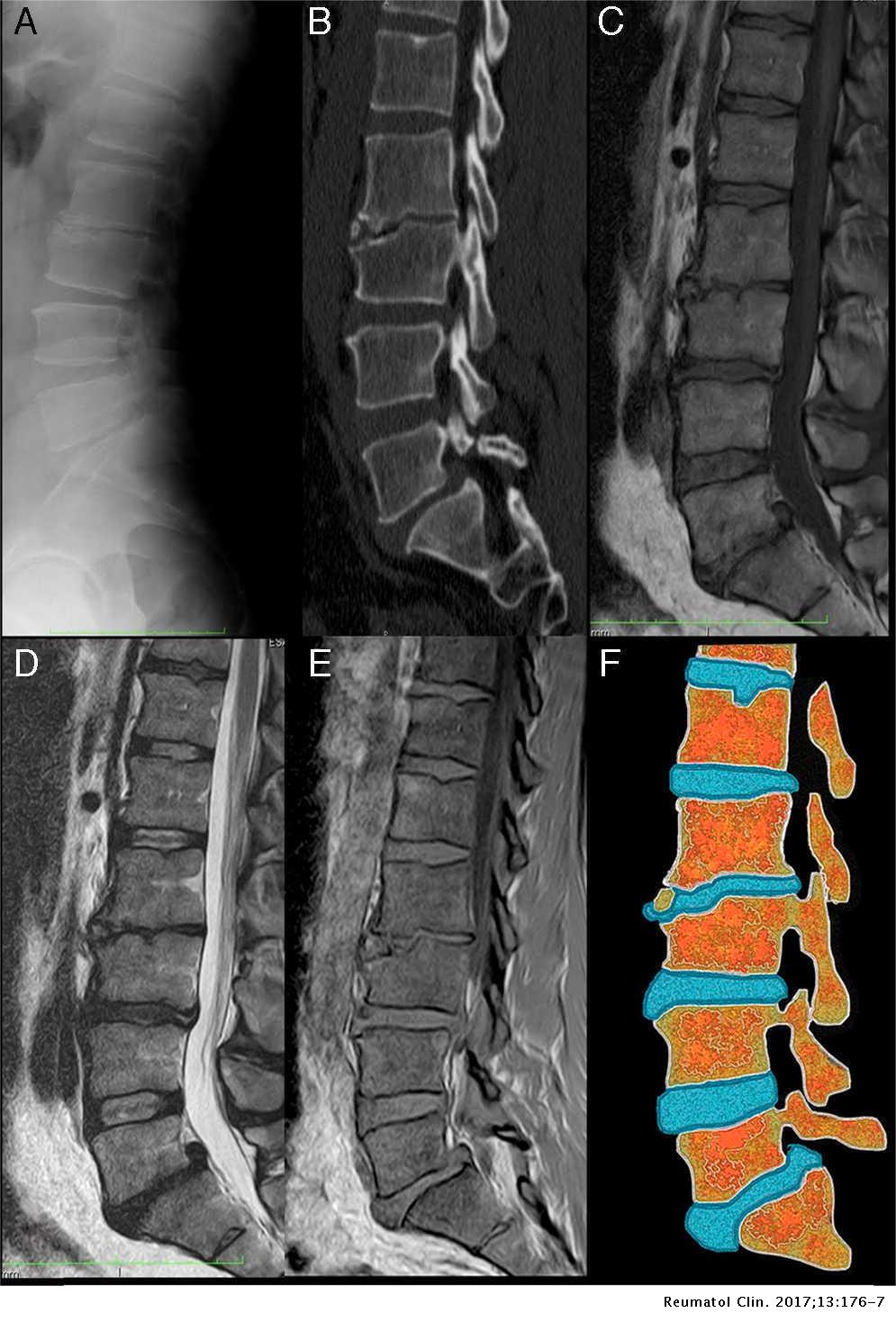 kil etkinleştirme tabii ki  Mechanical Low Back Pain as a Presentation of Anterior Limbus Vertebra |  Reumatología Clínica