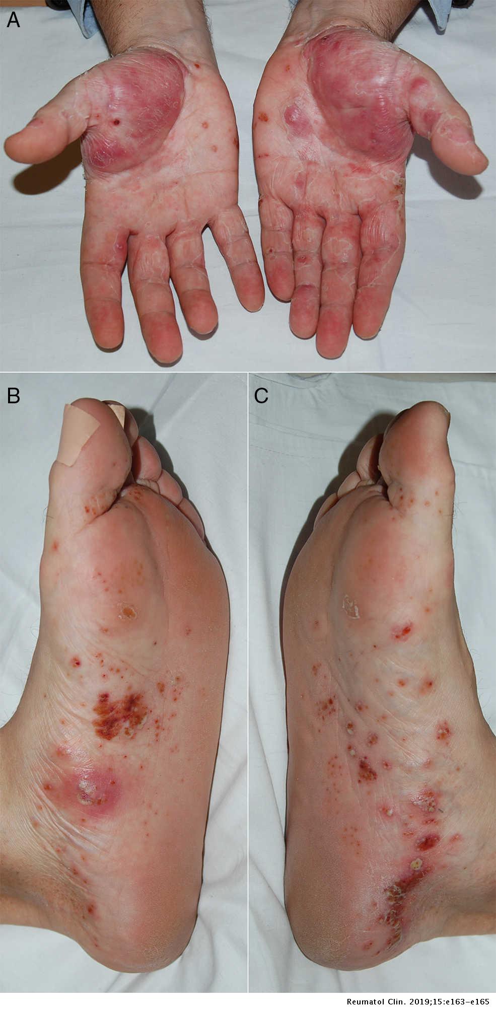 seborrhoeás dermatitis krém szuper psori krém pikkelysömör krém