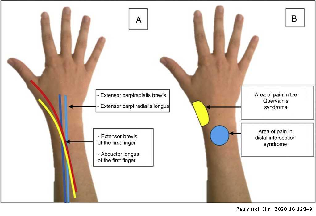 intersection syndrome wrist