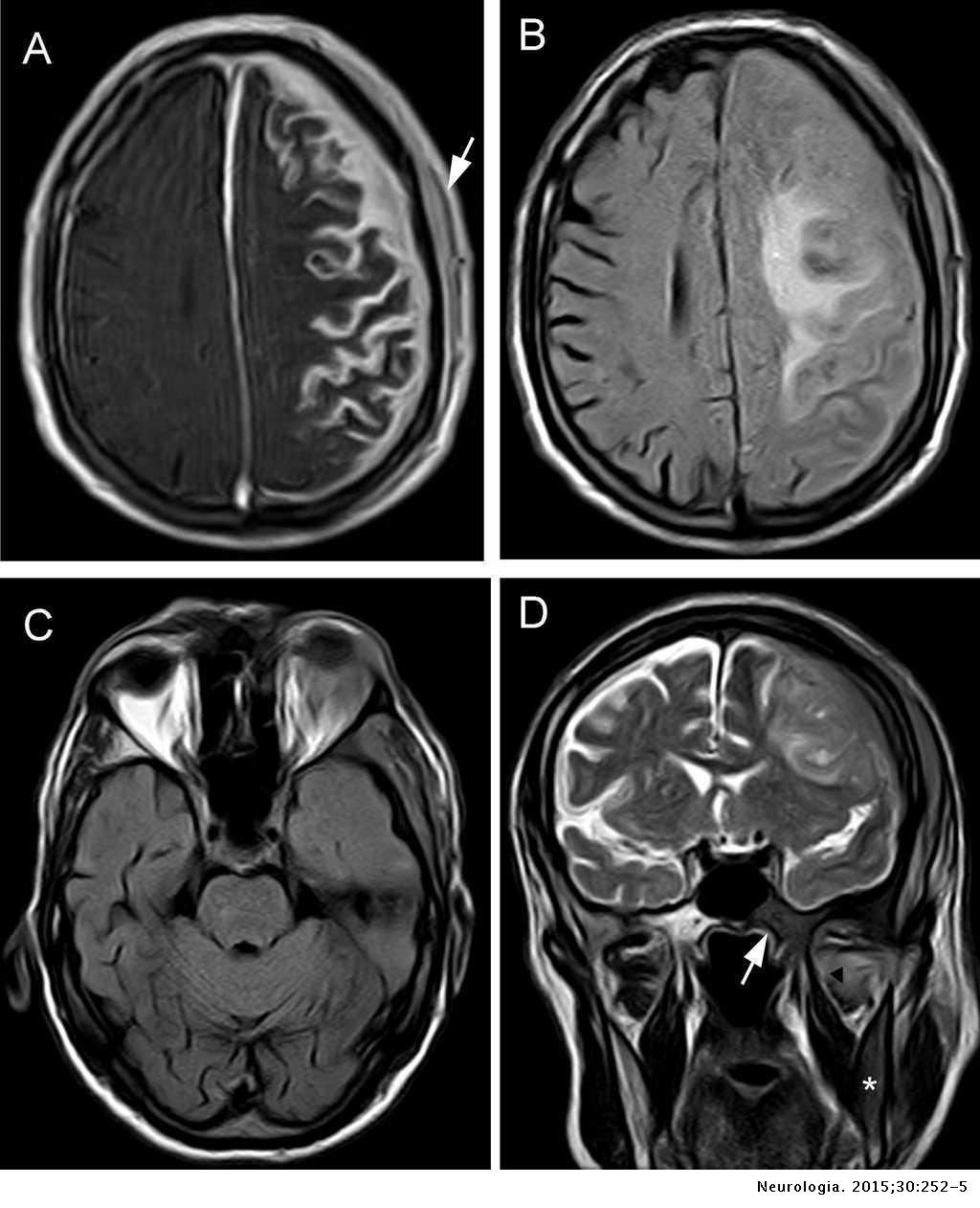 Bing Neel Syndrome As An Initial Sign Of Waldenstrom Macroglobulinaemia Associated With Orbital Infiltration Neurologia English Edition Bing Neel Syndrome As An Initial Sign Of Waldenstrom Macroglobulinaemia Associated With Orbital Infiltration Neurologia English Edition