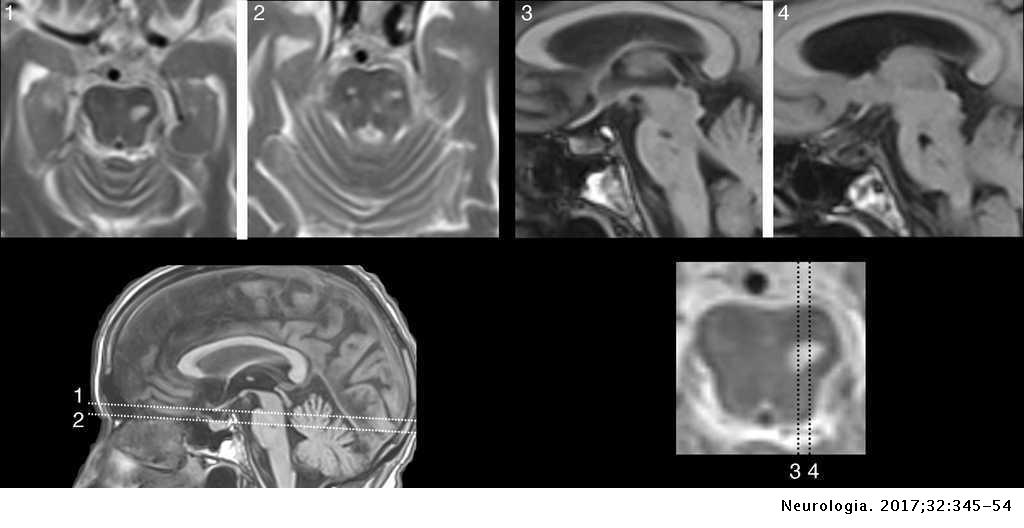 Auditory Hallucinations In Cognitive Neurology Neurologia