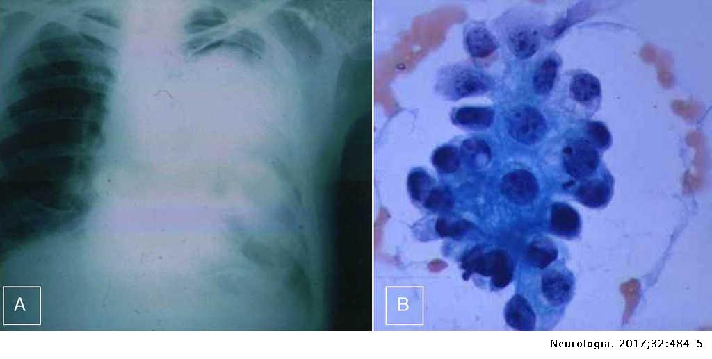 malignant pleural effusion adenocarcinoma