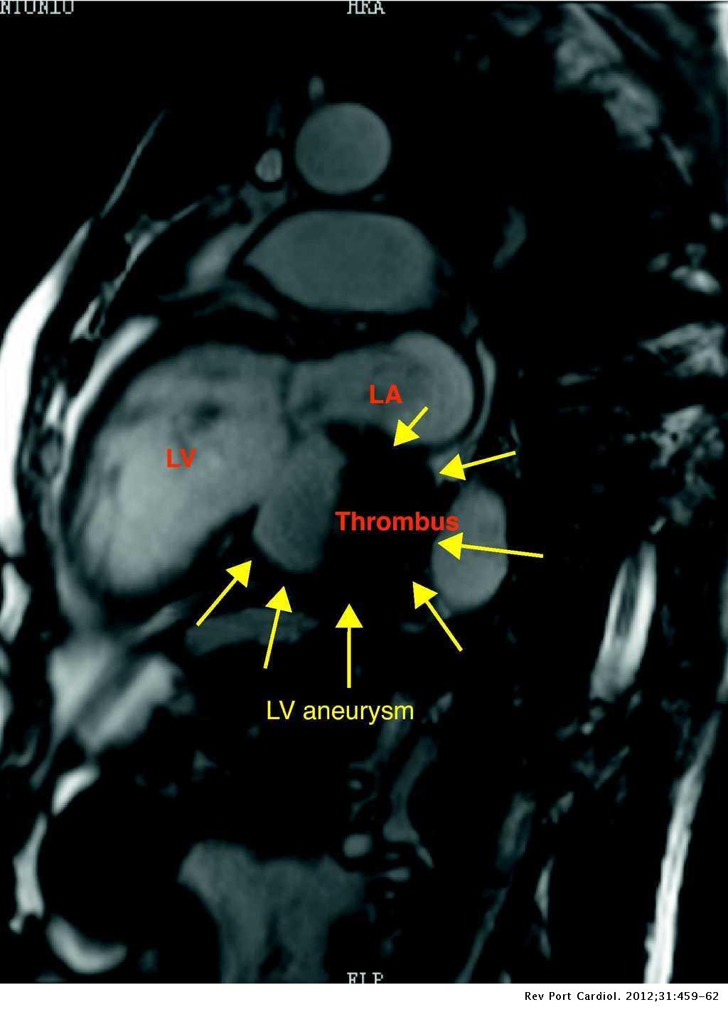 Left ventricular aneurysm and differential diagnosis with pseudoaneurysm | Revista Portuguesa de ...