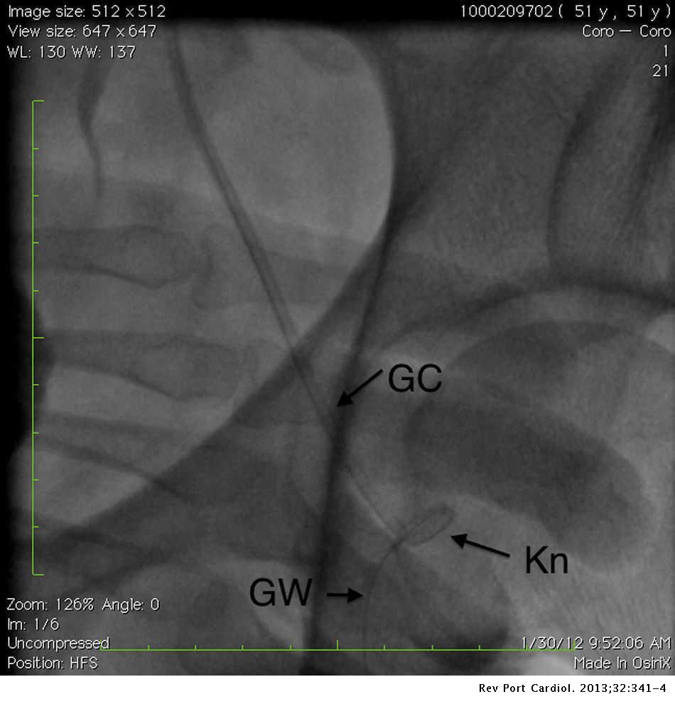 Fracture Of A Guiding Catheter In A Tortuous Iliac Artery And Its Retrieval By A Larger Sheath Revista Portuguesa De Cardiologia English Edition