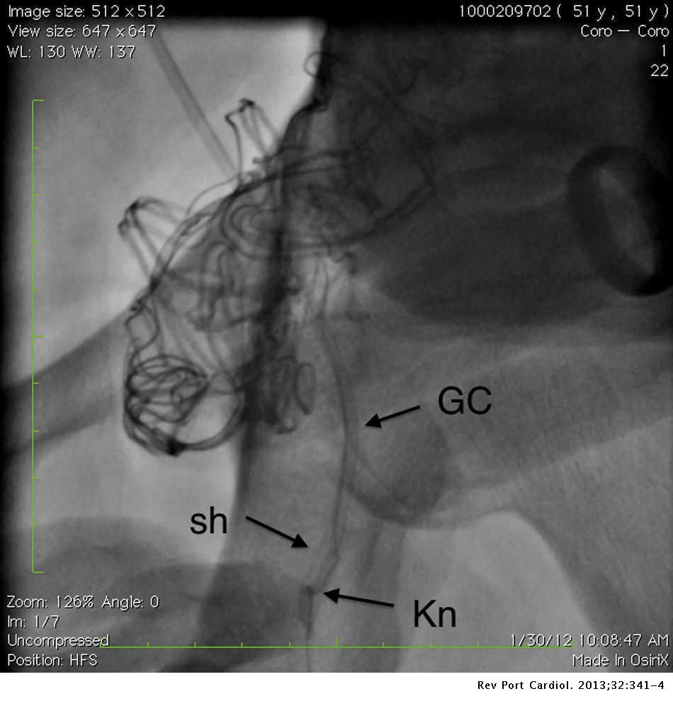 Fracture Of A Guiding Catheter In A Tortuous Iliac Artery And Its Retrieval By A Larger Sheath Revista Portuguesa De Cardiologia English Edition