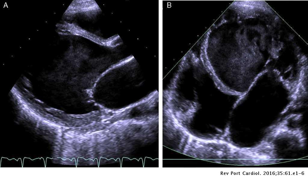 Left ventricular noncompaction: A rare indication for pediatric heart transplantation | Revista ...