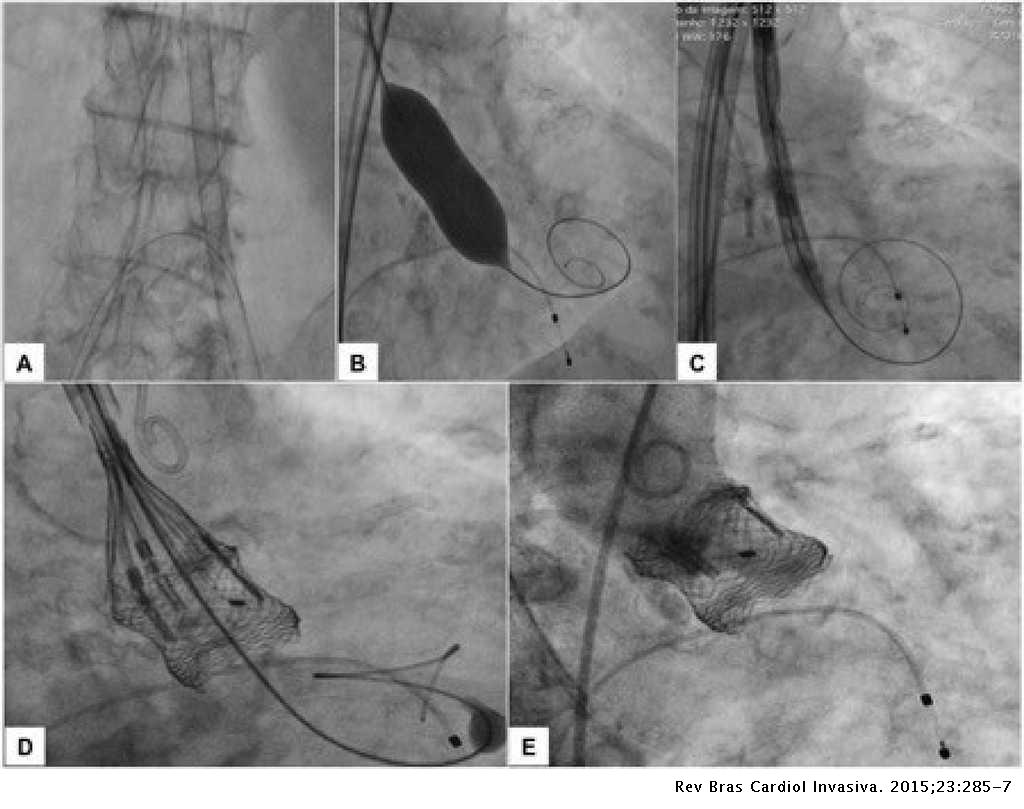 Minimally Invasive Strategy For Transcatheter Implantation Of Second Generation Lotus Aortic Valve System Revista Brasileira De Cardiologia Invasiva English Edition