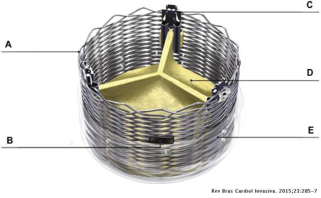 Minimally Invasive Strategy For Transcatheter Implantation Of Second Generation Lotus Aortic Valve System Revista Brasileira De Cardiologia Invasiva English Edition