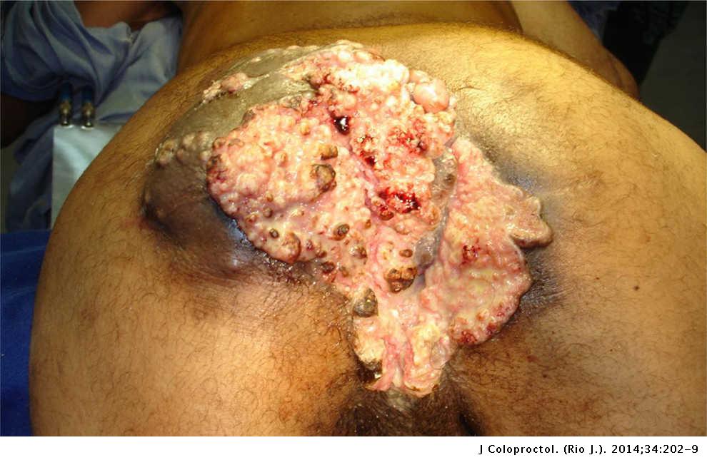 condyloma bushke terapia verucilor genitale