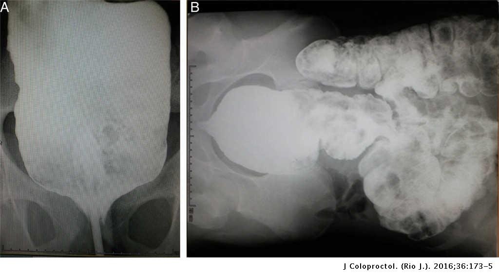 Idiopathic megacolon in a teenager treated by laparoscopic 