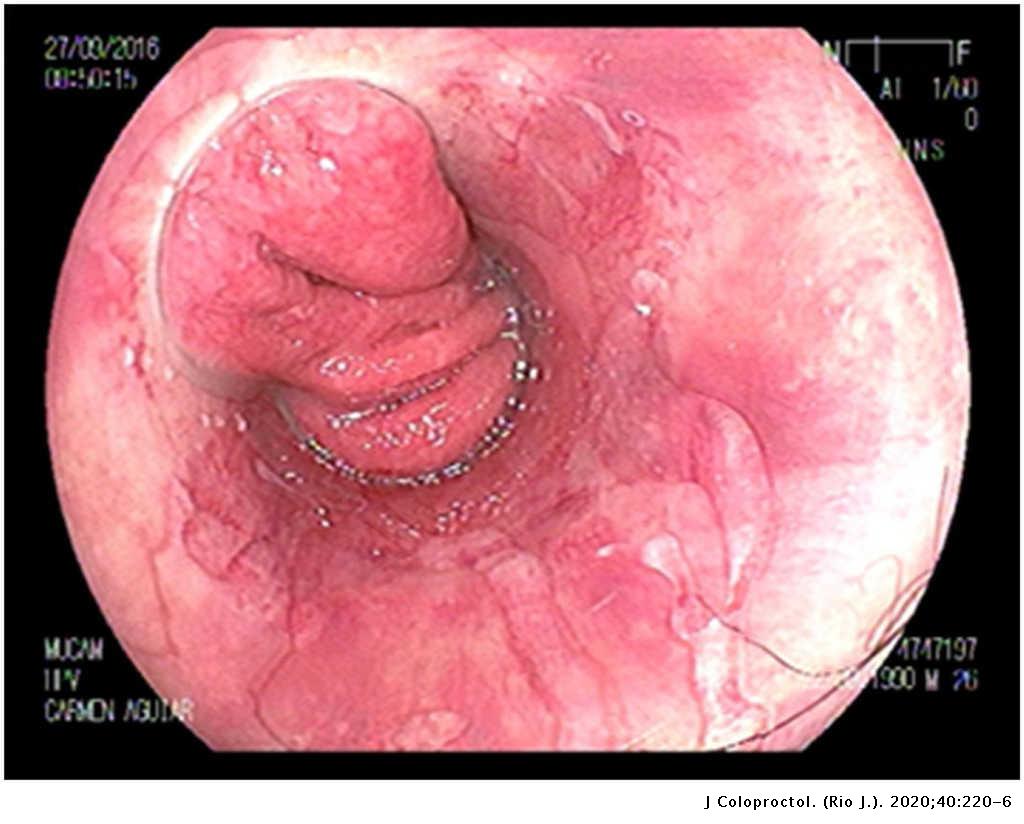 Papiloame pe anus HPV genotipare în leziune/raclat (regiunea anogenitală și orală)