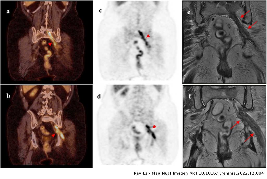 Sciatic nerve tumoral infiltration: 18F-FDG PET/CT findings | Revista ...