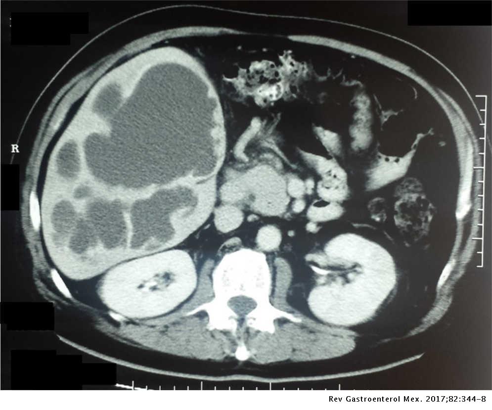 A Brief History Of Amoebic Liver Abscess With An Illustrative Case