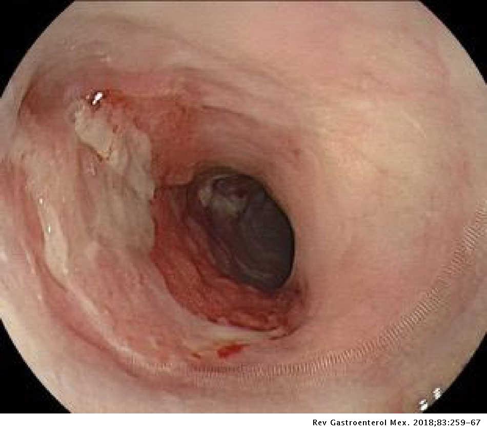 Early esophageal squamous cell carcinoma management through endoscopic